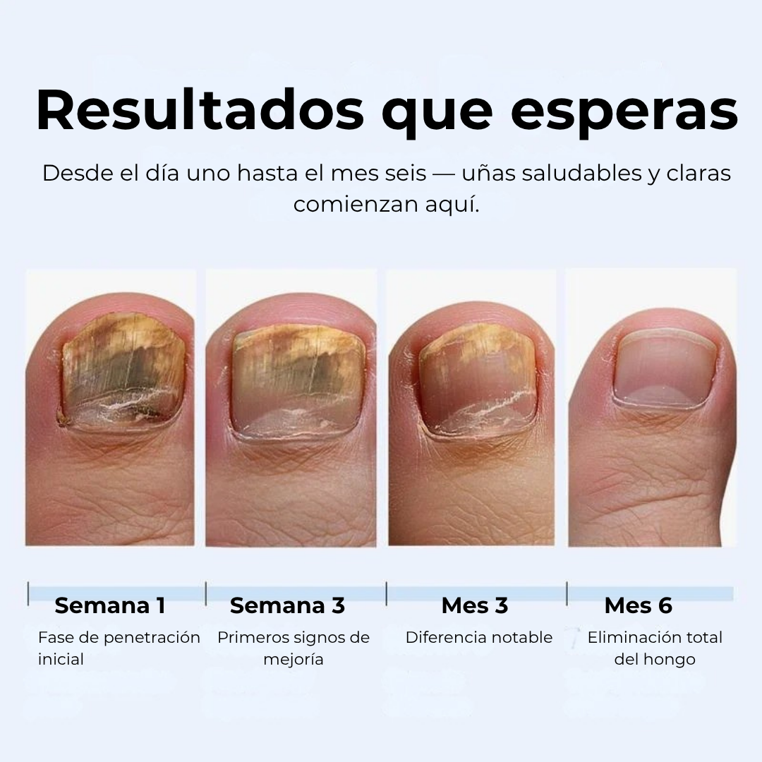 MyCurePro® Lápiz Antifúngico con Fórmula Avanzada – Contra Pie de Atleta y Hongos en Uñas