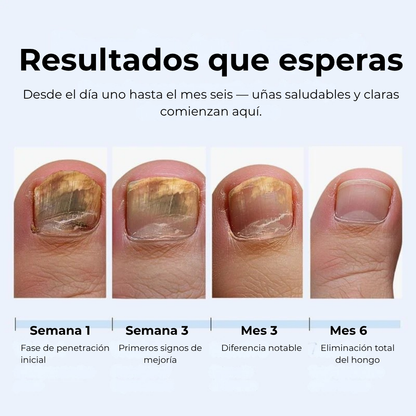 MyCurePro® Lápiz Antifúngico con Fórmula Avanzada – Contra Pie de Atleta y Hongos en Uñas